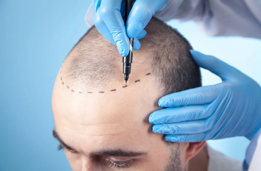 Hair transplant Turkey: Affordable and Reliable Treatment
